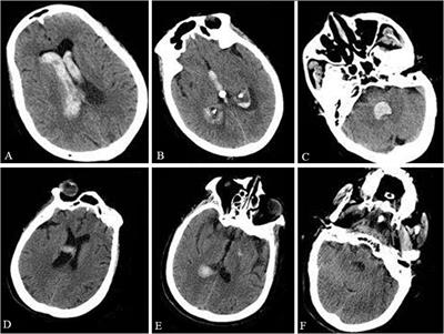 Fulminant Guillain–Barré Syndrome and Spontaneous Intraventricular Hemorrhage: A Case Report and Literature Review